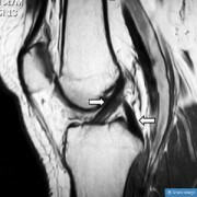 Posterior_cruciate_ligament-180x180