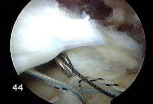 arthroscopic-rotator-cuff-repair